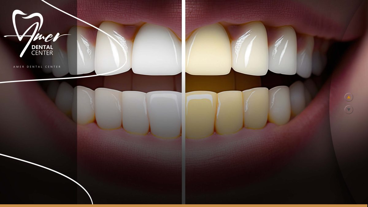 سعر تبييض الاسنان